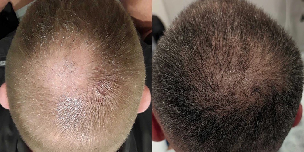 medical hair restoration